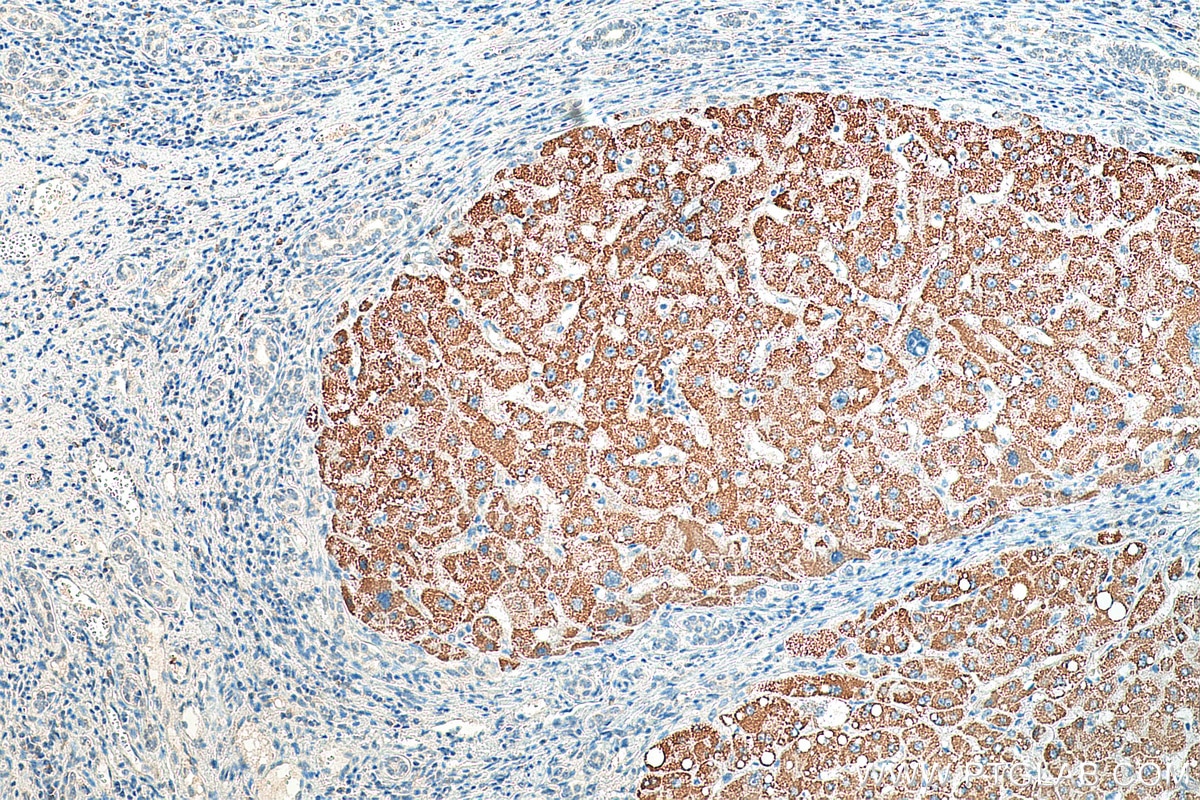 Immunohistochemistry (IHC) staining of human liver cancer tissue using NMT1 Monoclonal antibody (67984-1-Ig)