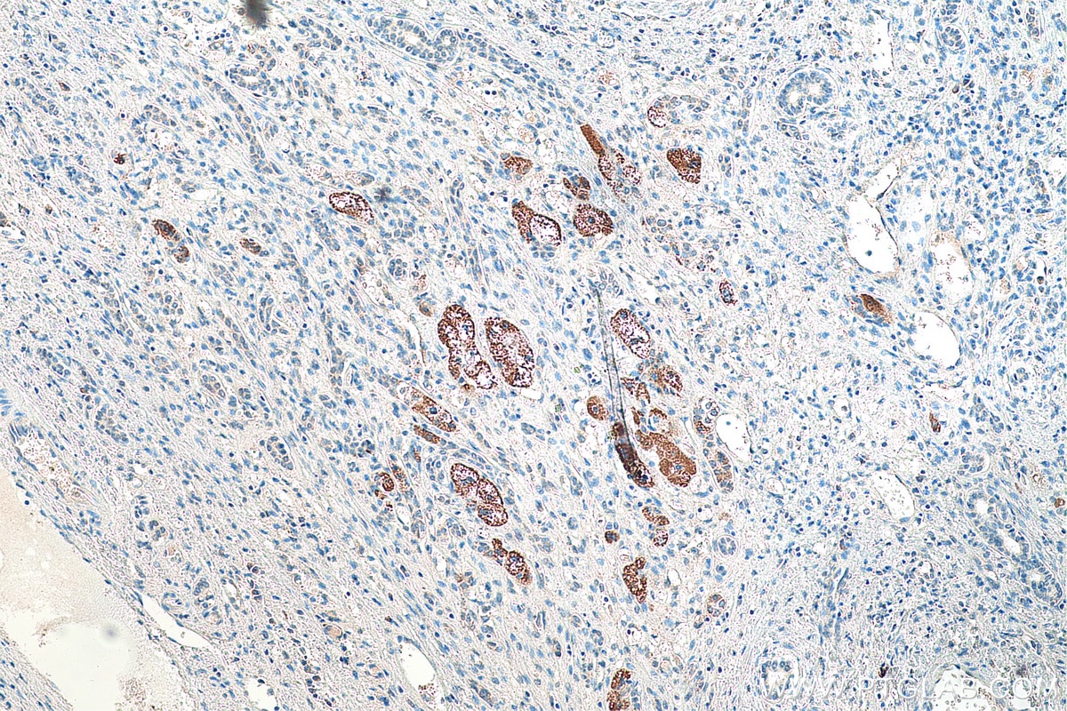 Immunohistochemistry (IHC) staining of human liver cancer tissue using NMT1 Monoclonal antibody (67984-1-Ig)