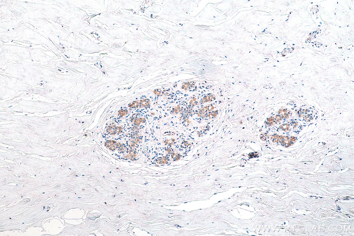 Immunohistochemistry (IHC) staining of human breast cancer tissue using NMT1 Monoclonal antibody (67984-1-Ig)