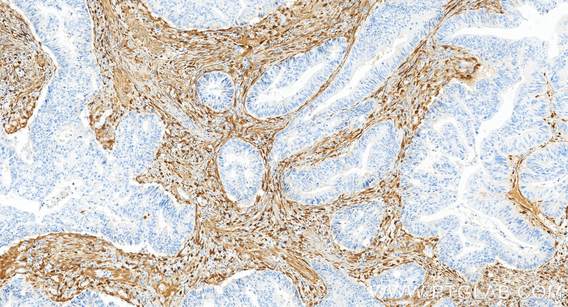 Immunohistochemistry (IHC) staining of human colon cancer tissue using NNMT Recombinant monoclonal antibody (84876-9-RR)