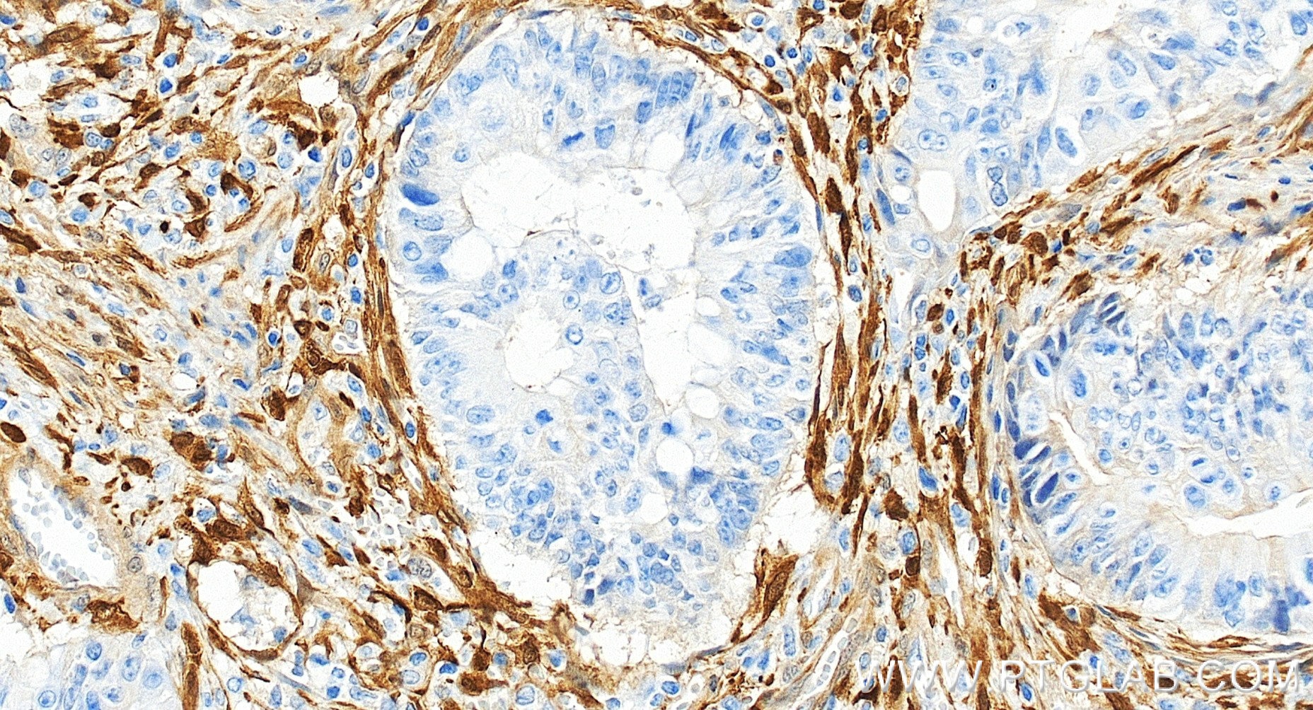 Immunohistochemistry (IHC) staining of human colon cancer tissue using NNMT Recombinant monoclonal antibody (84876-9-RR)