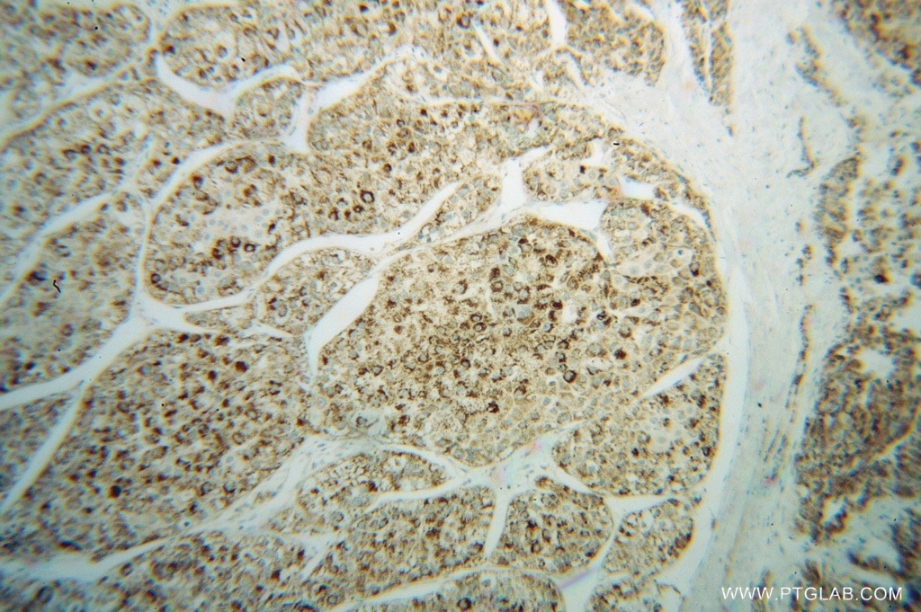 Immunohistochemistry (IHC) staining of human liver cancer tissue using NNT Polyclonal antibody (13442-2-AP)