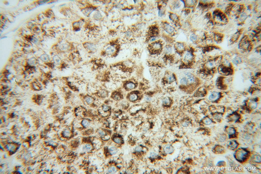 Immunohistochemistry (IHC) staining of human liver cancer tissue using NNT Polyclonal antibody (13442-2-AP)