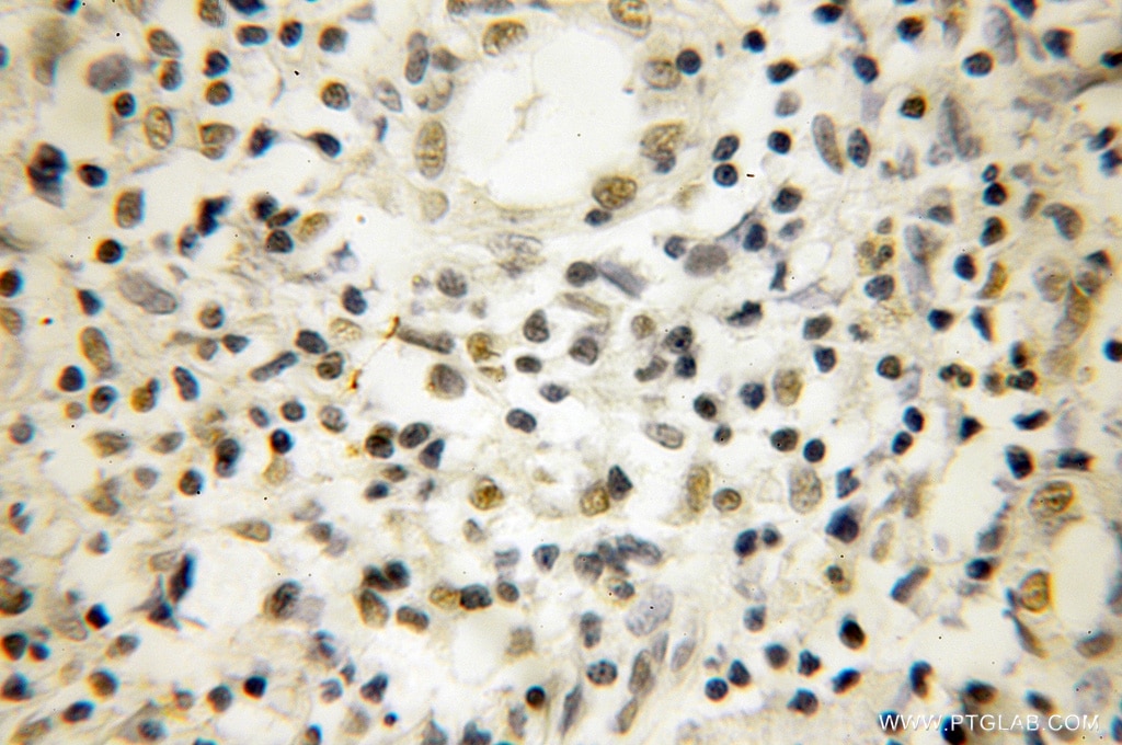 Immunohistochemistry (IHC) staining of human lymphoma tissue using NOB1 Polyclonal antibody (10091-2-AP)