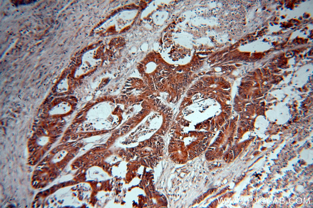 Immunohistochemistry (IHC) staining of human colon cancer tissue using NOB1 Polyclonal antibody (10091-2-AP)