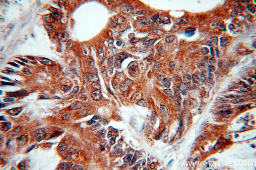 Immunohistochemistry (IHC) staining of human colon cancer tissue using NOB1 Polyclonal antibody (10091-2-AP)
