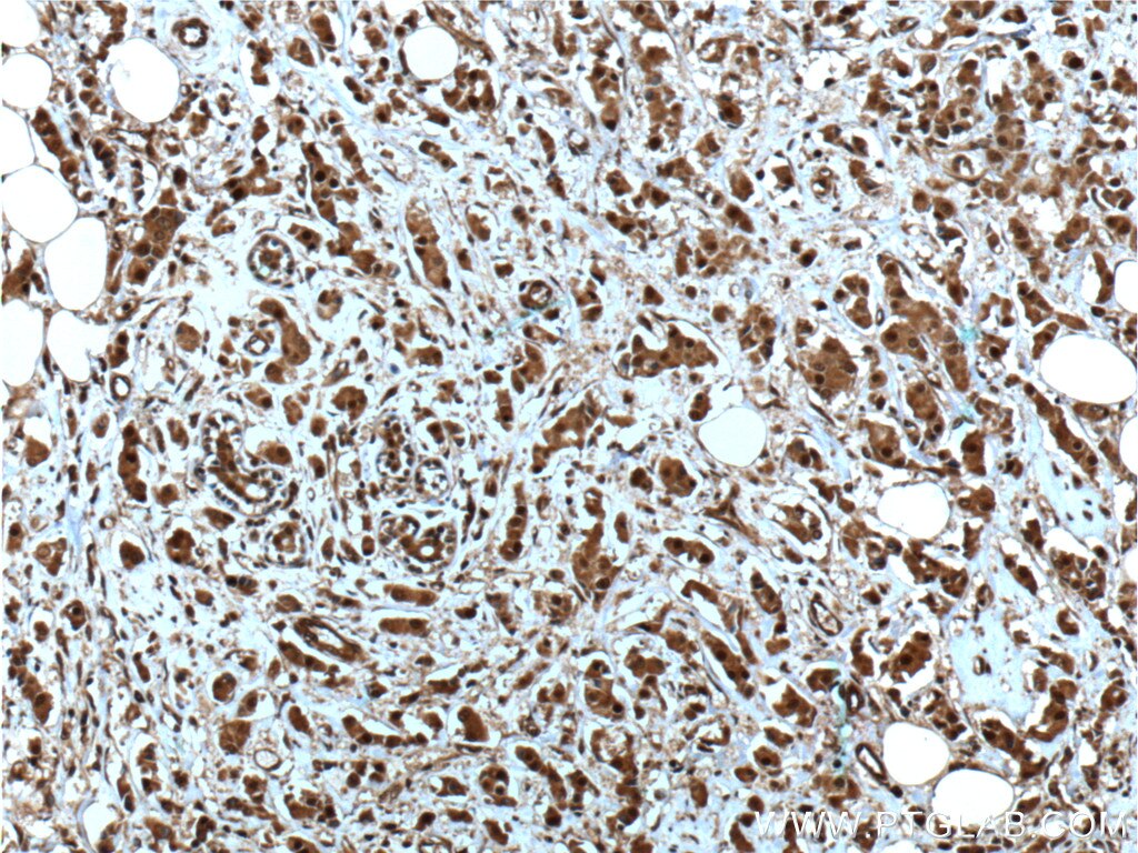 Immunohistochemistry (IHC) staining of human breast cancer tissue using NOB1 Monoclonal antibody (66048-1-Ig)