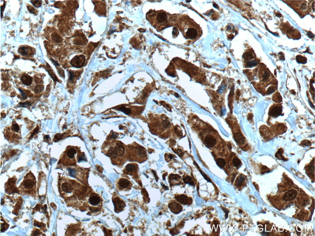 Immunohistochemistry (IHC) staining of human breast cancer tissue using NOB1 Monoclonal antibody (66048-1-Ig)