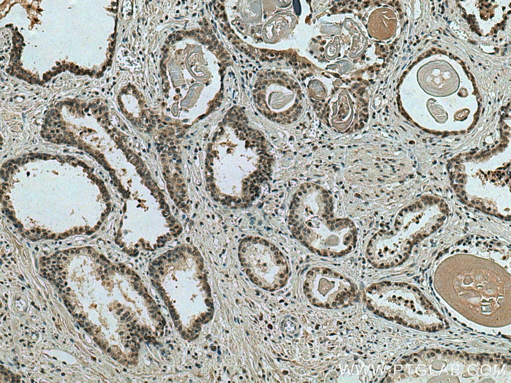 Immunohistochemistry (IHC) staining of human prostate cancer tissue using NOC2L Polyclonal antibody (28509-1-AP)