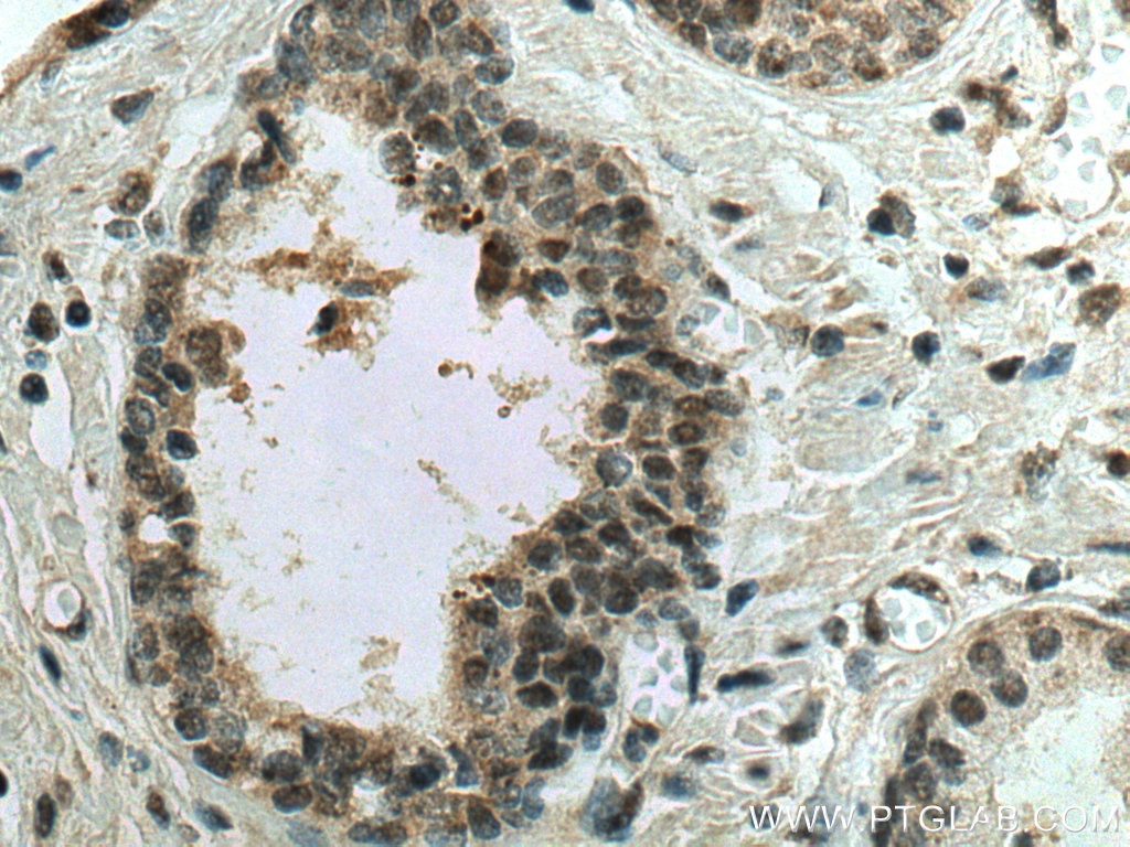 Immunohistochemistry (IHC) staining of human prostate cancer tissue using NOC2L Polyclonal antibody (28509-1-AP)