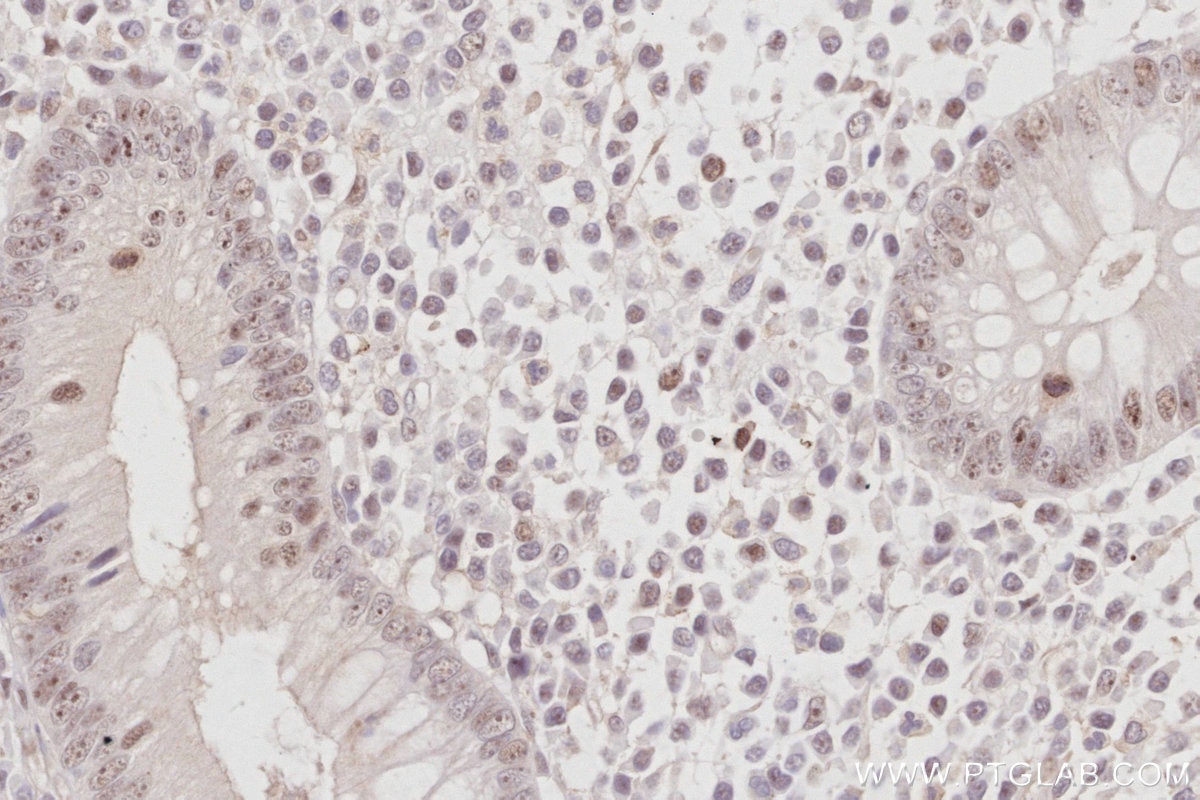 IHC staining of human appendicitis using 28509-1-AP Immunohistochemistry (IHC) staining of human appendicitis tissue using NOC2L Polyclonal antibody (28509-1-AP)
