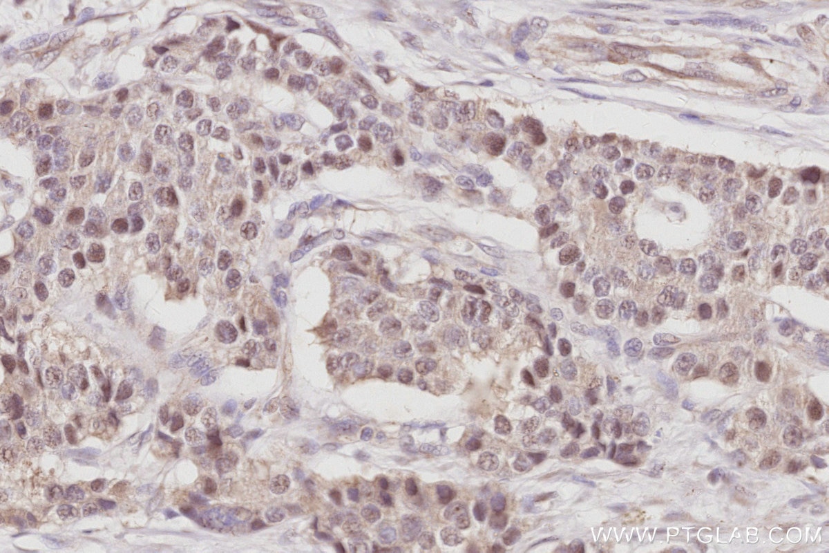 IHC staining of human stomach cancer using 28509-1-AP Immunohistochemistry (IHC) staining of human stomach cancer tissue using NOC2L Polyclonal antibody (28509-1-AP)