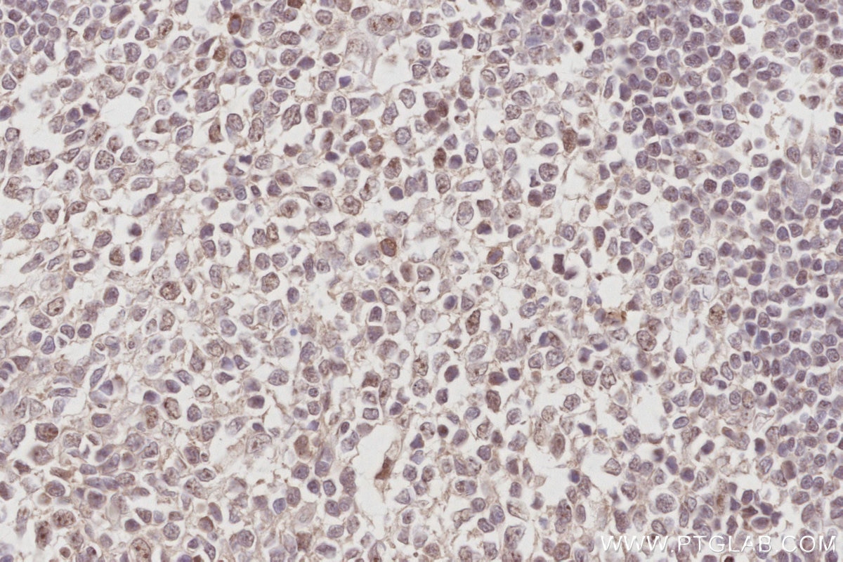 IHC staining of human appendicitis using 28509-1-AP Immunohistochemistry (IHC) staining of human appendicitis tissue using NOC2L Polyclonal antibody (28509-1-AP)