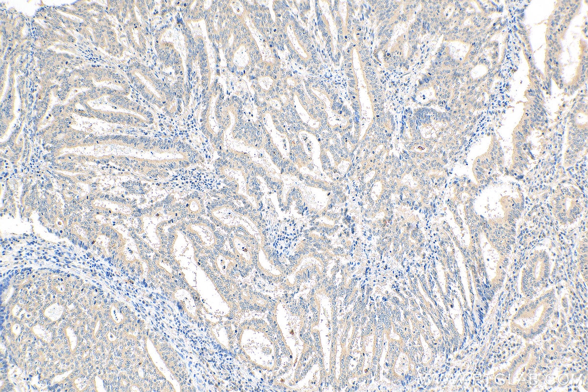 IHC staining of human endometrial cancer using 27430-1-AP