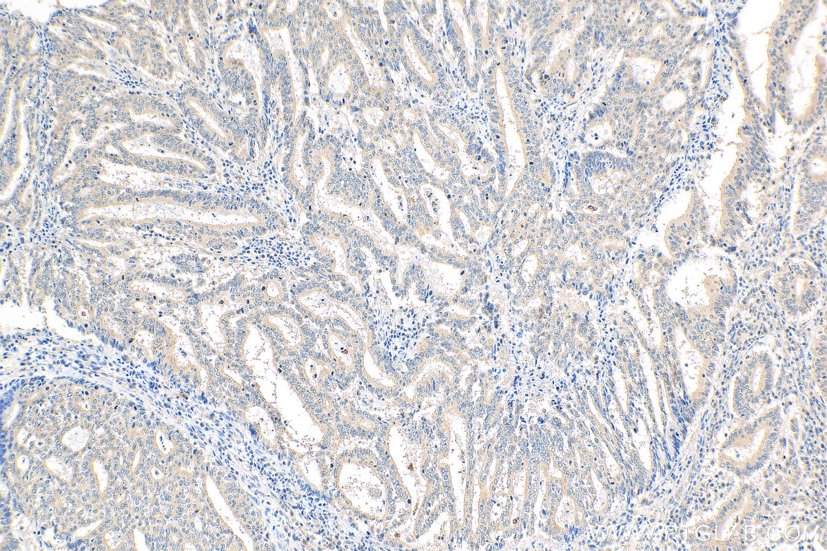 Immunohistochemistry (IHC) staining of human endometrial cancer tissue using NODAL Polyclonal antibody (27430-1-AP)