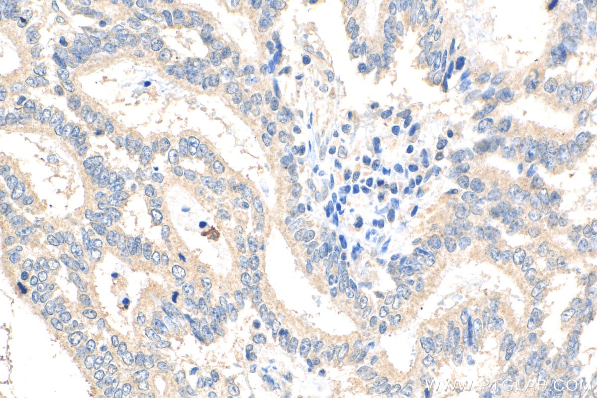 Immunohistochemistry (IHC) staining of human endometrial cancer tissue using NODAL Polyclonal antibody (27430-1-AP)