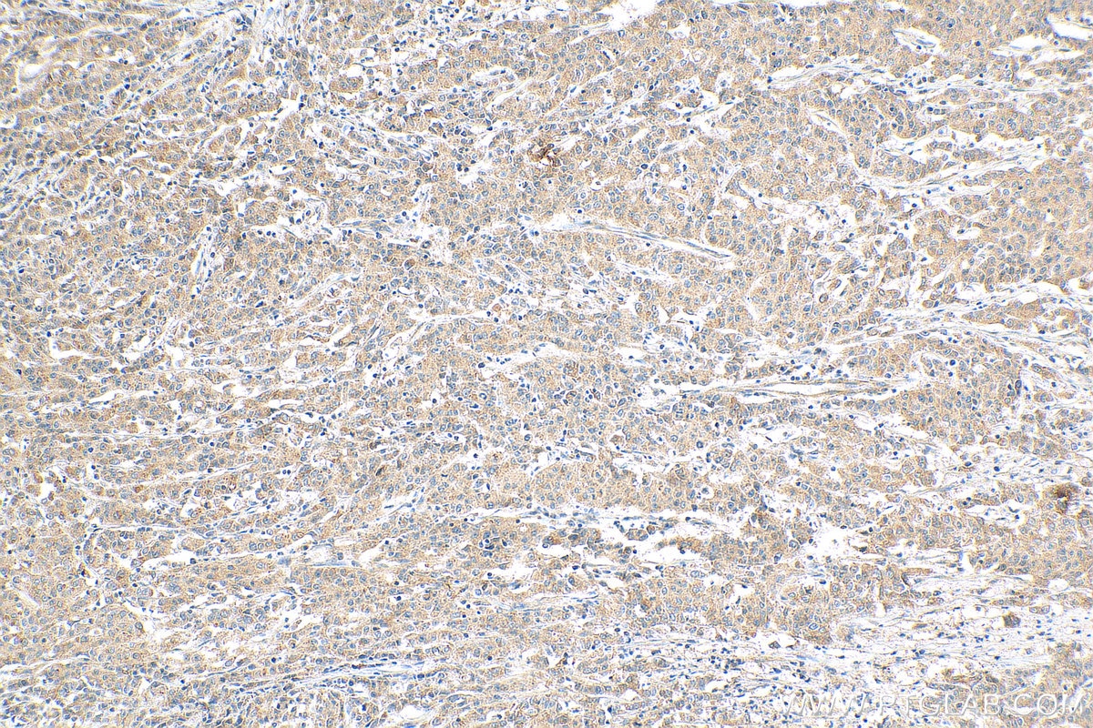 Immunohistochemistry (IHC) staining of human stomach cancer tissue using NODAL Polyclonal antibody (27430-1-AP)