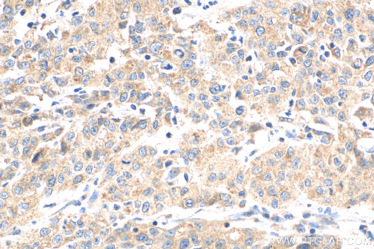 Immunohistochemistry (IHC) staining of human stomach cancer tissue using NODAL Polyclonal antibody (27430-1-AP)