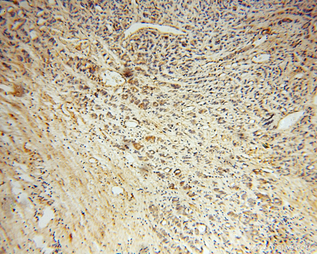 Immunohistochemistry (IHC) staining of human gliomas tissue using Noggin Polyclonal antibody (14772-1-AP)