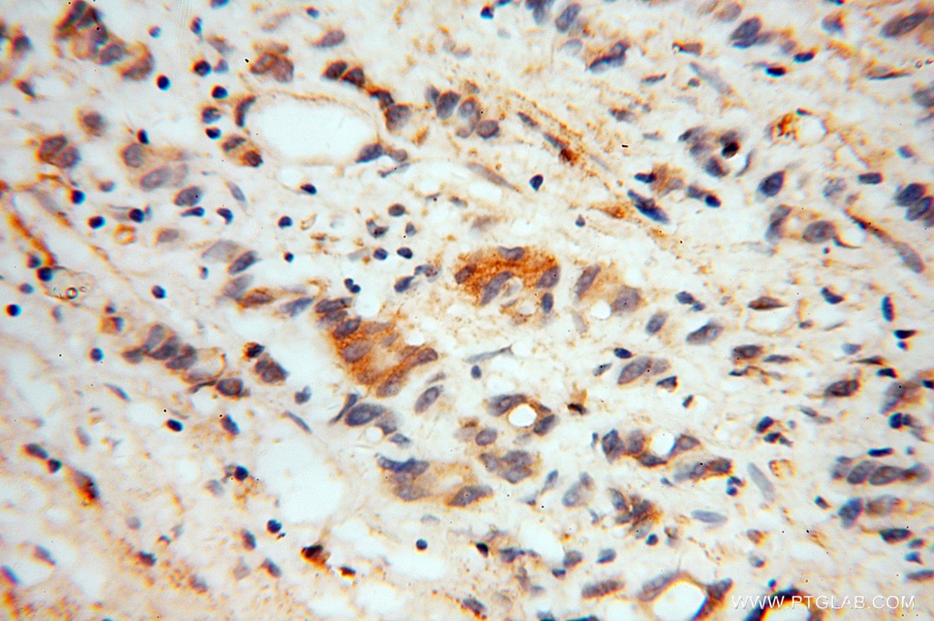 Immunohistochemistry (IHC) staining of human gliomas tissue using Noggin Polyclonal antibody (14772-1-AP)
