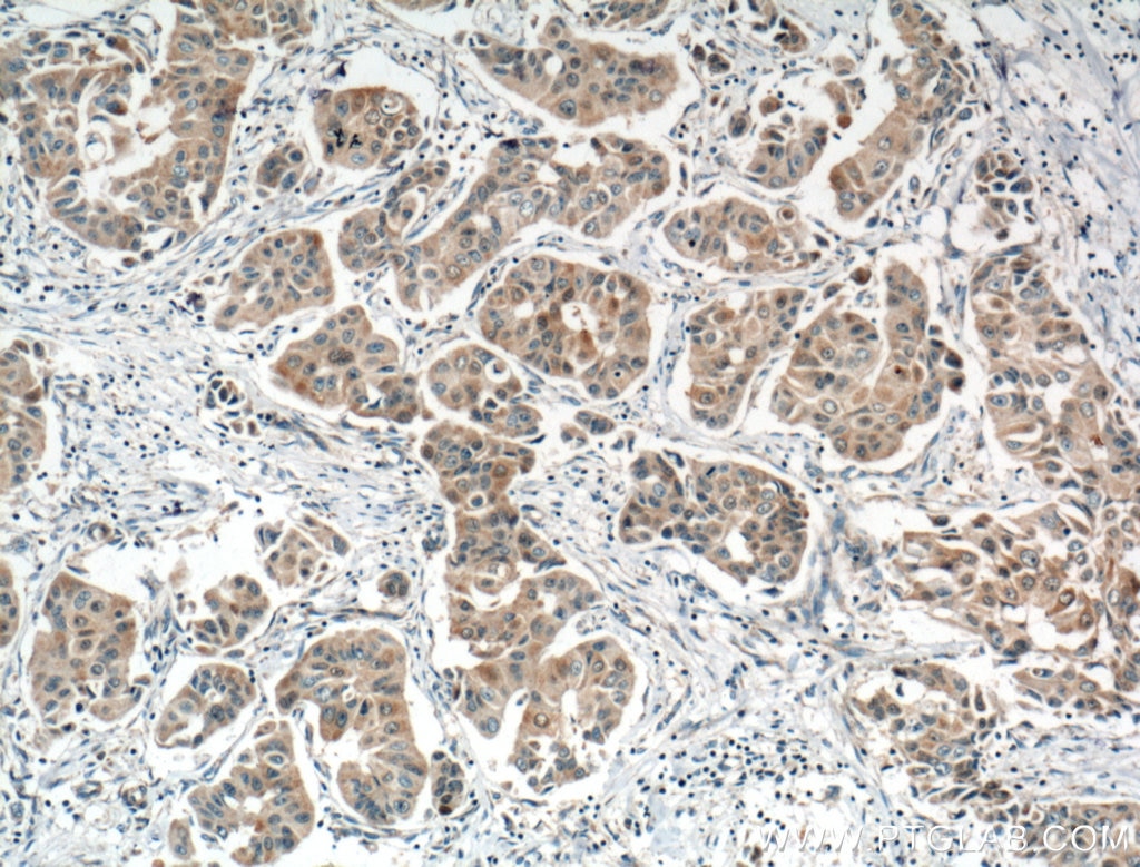 Immunohistochemistry (IHC) staining of human breast cancer tissue using NOL3 Polyclonal antibody (10846-2-AP)