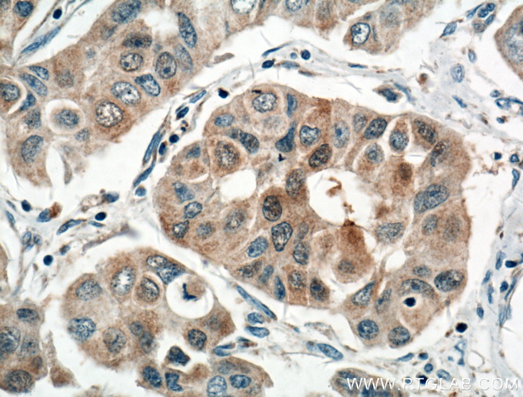 Immunohistochemistry (IHC) staining of human breast cancer tissue using NOL3 Polyclonal antibody (10846-2-AP)