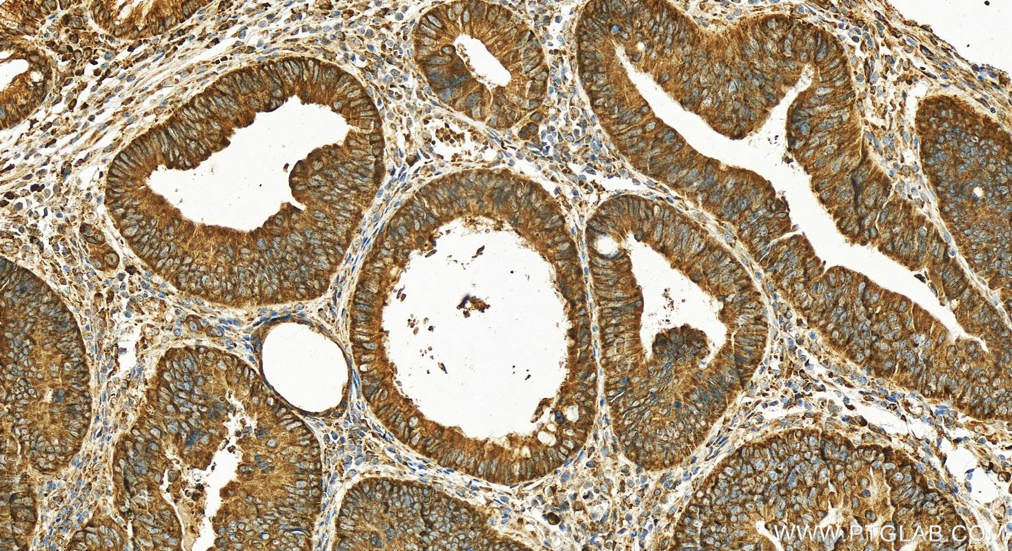 Immunohistochemistry (IHC) staining of human colon cancer tissue using NOMO1 Polyclonal antibody (17792-1-AP)