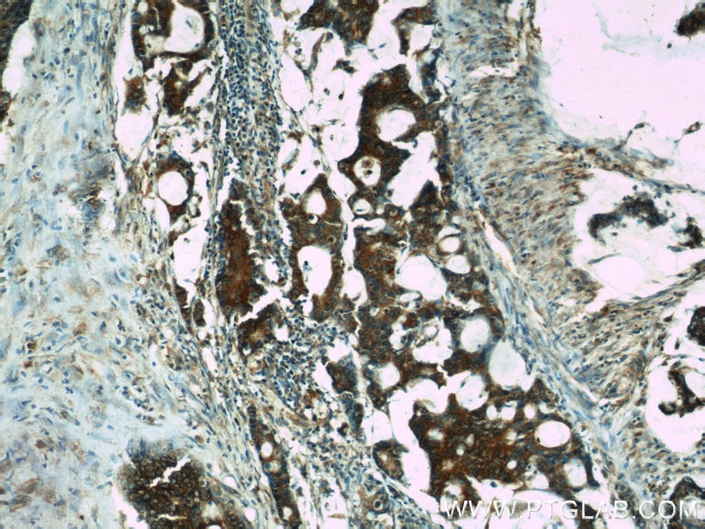 Immunohistochemistry (IHC) staining of human colon cancer tissue using NOMO1 Polyclonal antibody (17792-1-AP)