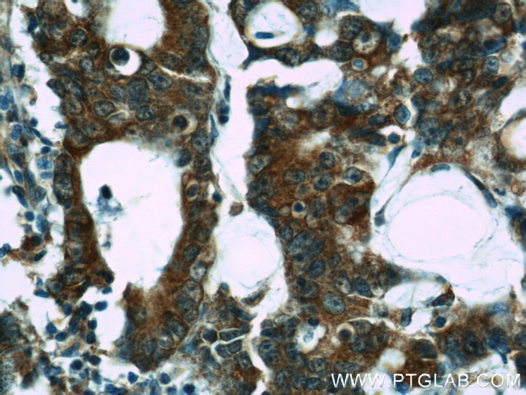 Immunohistochemistry (IHC) staining of human colon cancer tissue using NOMO1 Polyclonal antibody (17792-1-AP)