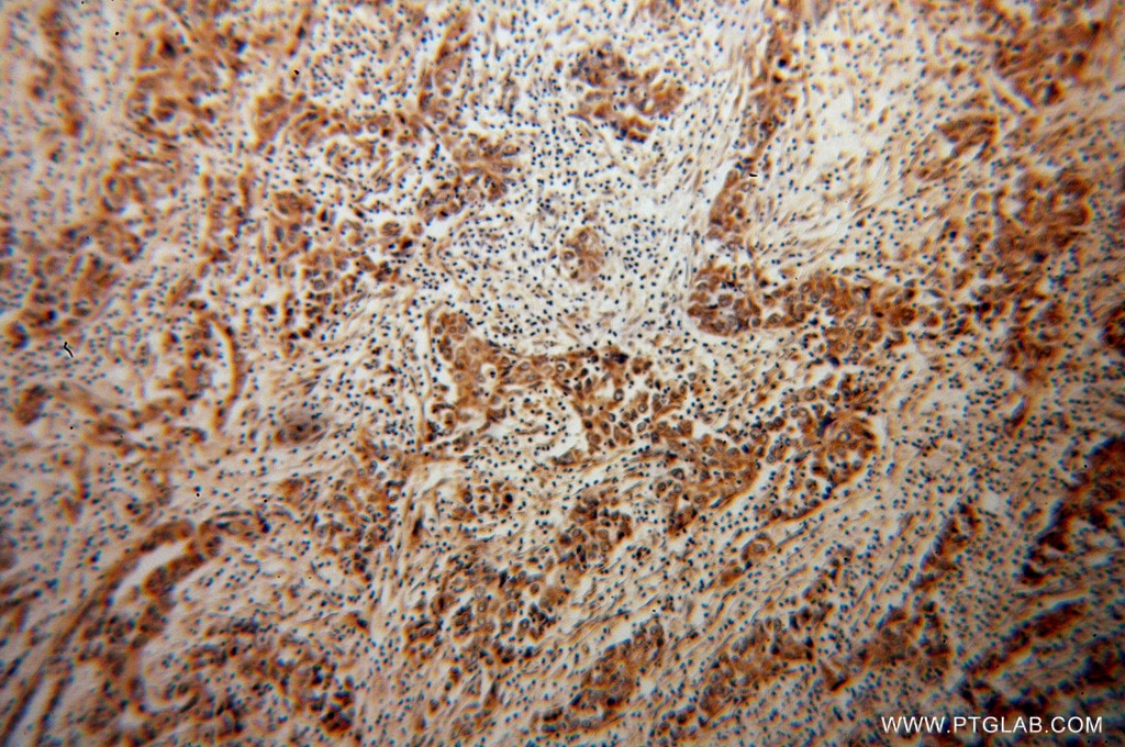 Immunohistochemistry (IHC) staining of human pancreas cancer tissue using NOMO2 Polyclonal antibody (14328-1-AP)