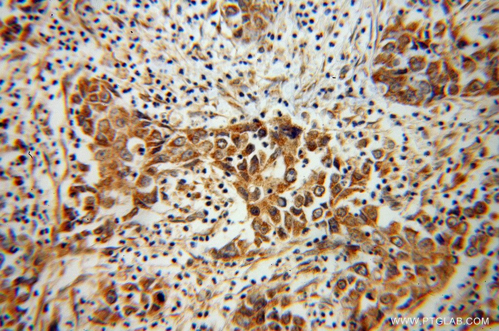 Immunohistochemistry (IHC) staining of human pancreas cancer tissue using NOMO2 Polyclonal antibody (14328-1-AP)