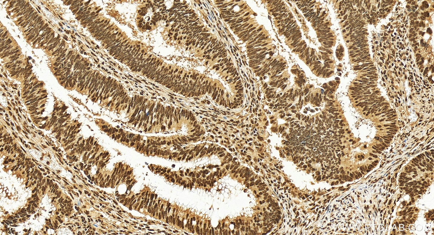 Immunohistochemistry (IHC) staining of human colon cancer tissue using NONO Polyclonal antibody (11058-1-AP)