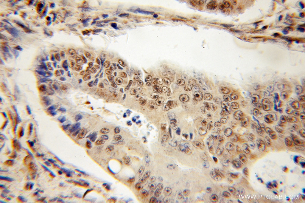 Immunohistochemistry (IHC) staining of human colon cancer tissue using NONO Polyclonal antibody (11058-1-AP)