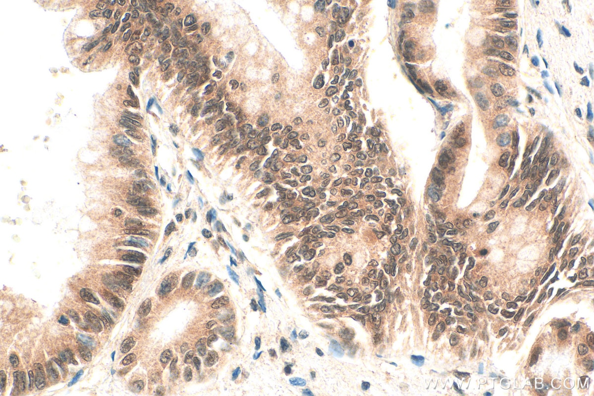 Immunohistochemistry (IHC) staining of human pancreas cancer tissue using NOP10 Polyclonal antibody (22769-1-AP)