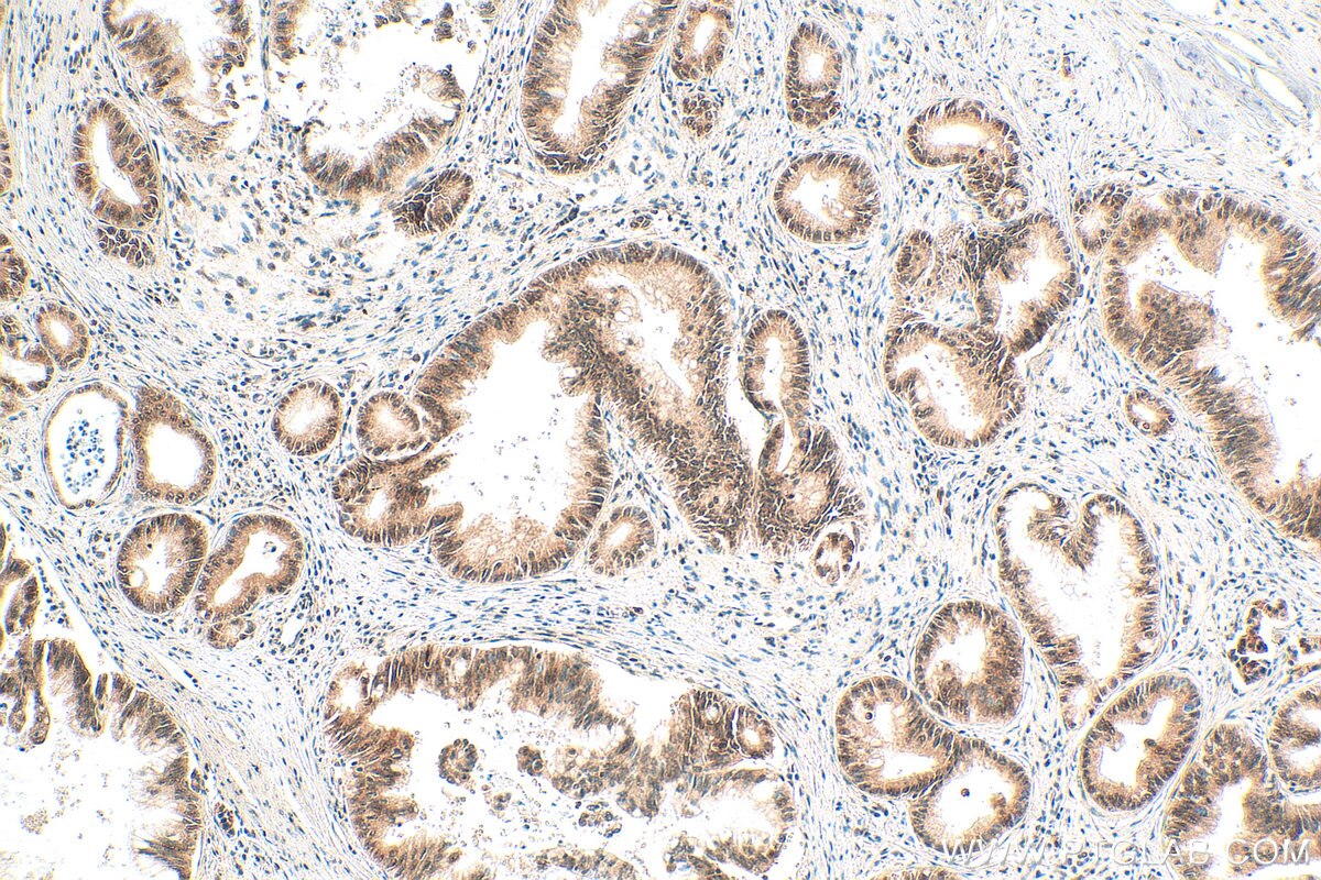 Immunohistochemistry (IHC) staining of human pancreas cancer tissue using NOP10 Polyclonal antibody (22769-1-AP)