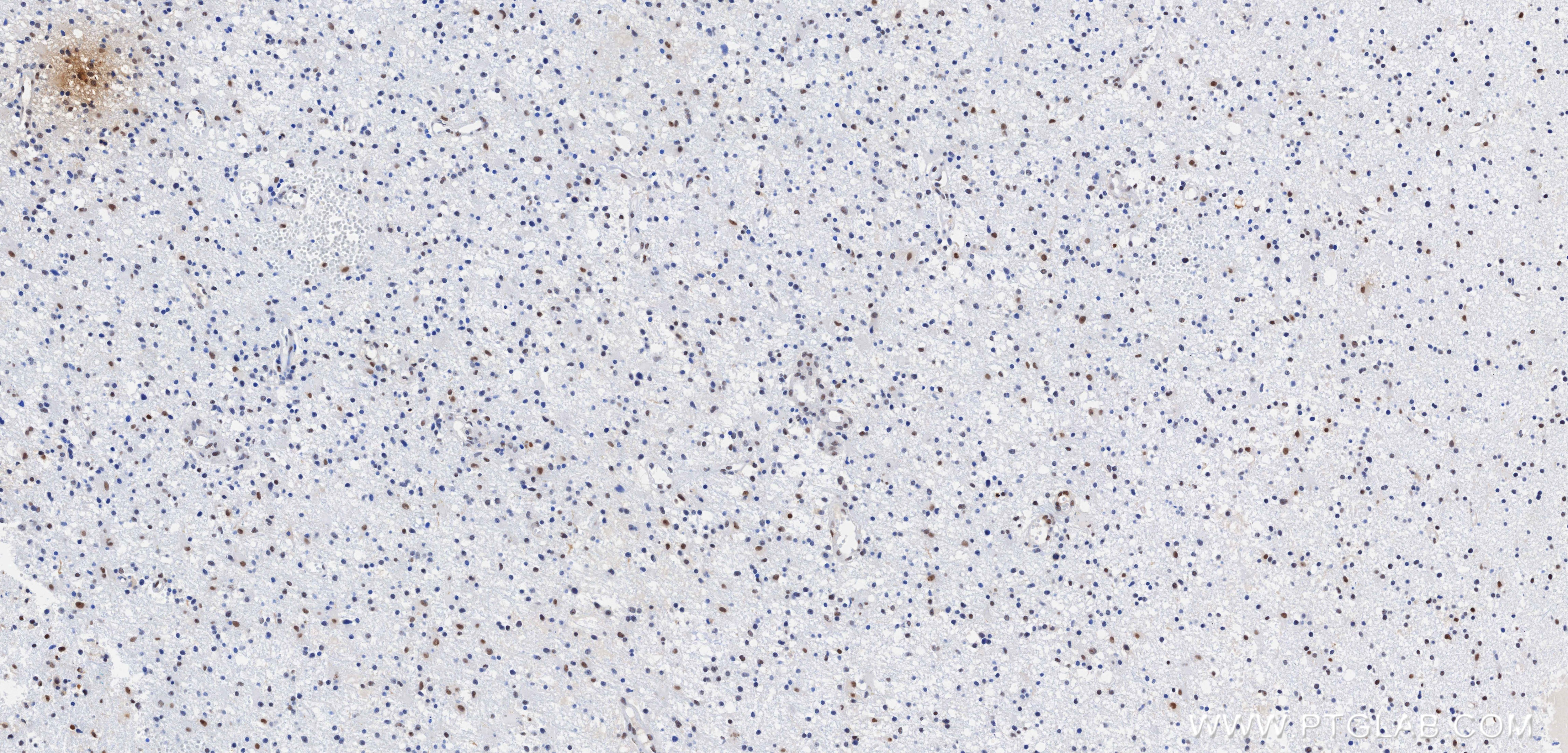 Immunohistochemistry (IHC) staining of Human brain cancer（Astrocitoma） using NOP10 Recombinant monoclonal antibody (87529-1-RR)