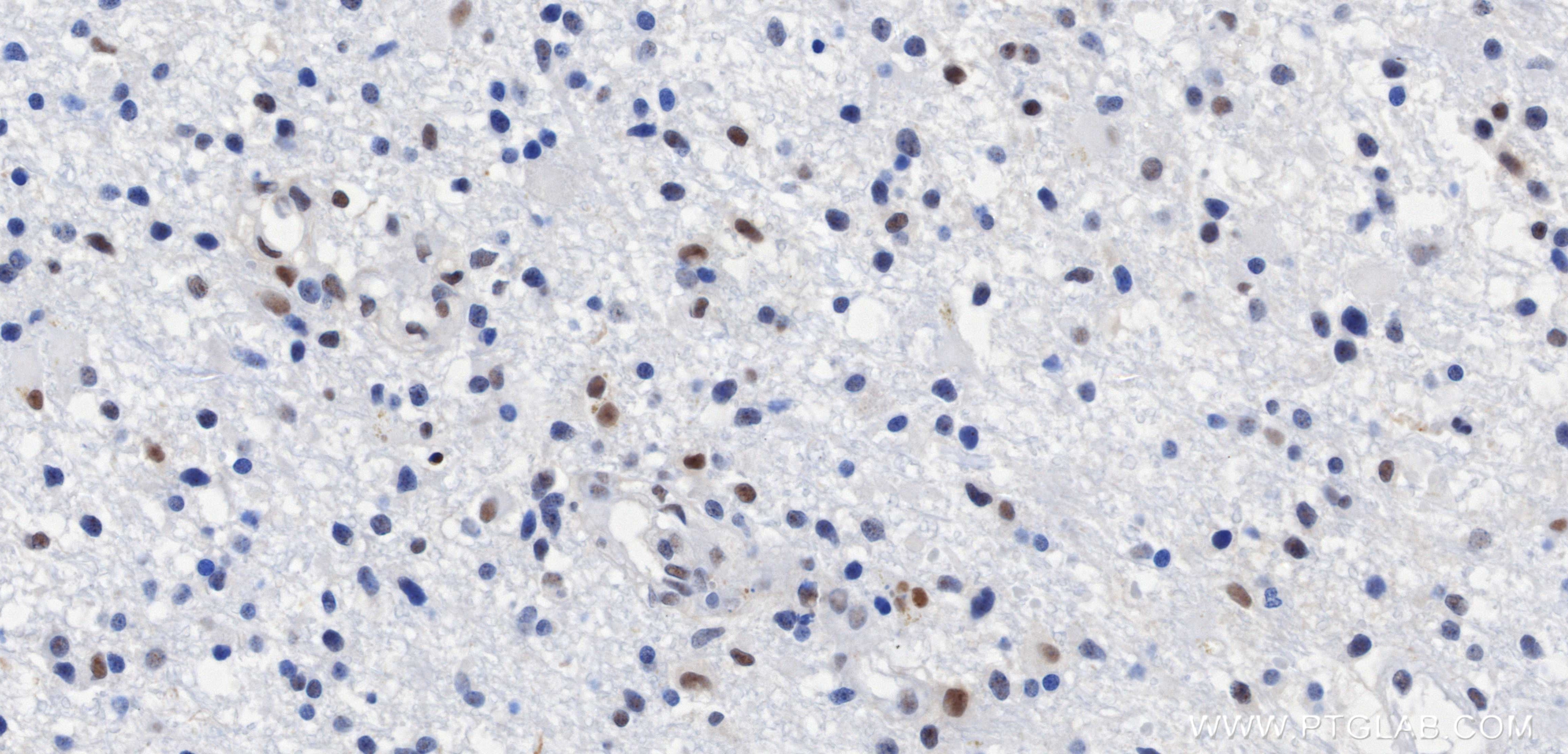 Immunohistochemistry (IHC) staining of Human brain cancer（Astrocitoma） using NOP10 Recombinant monoclonal antibody (87529-1-RR)