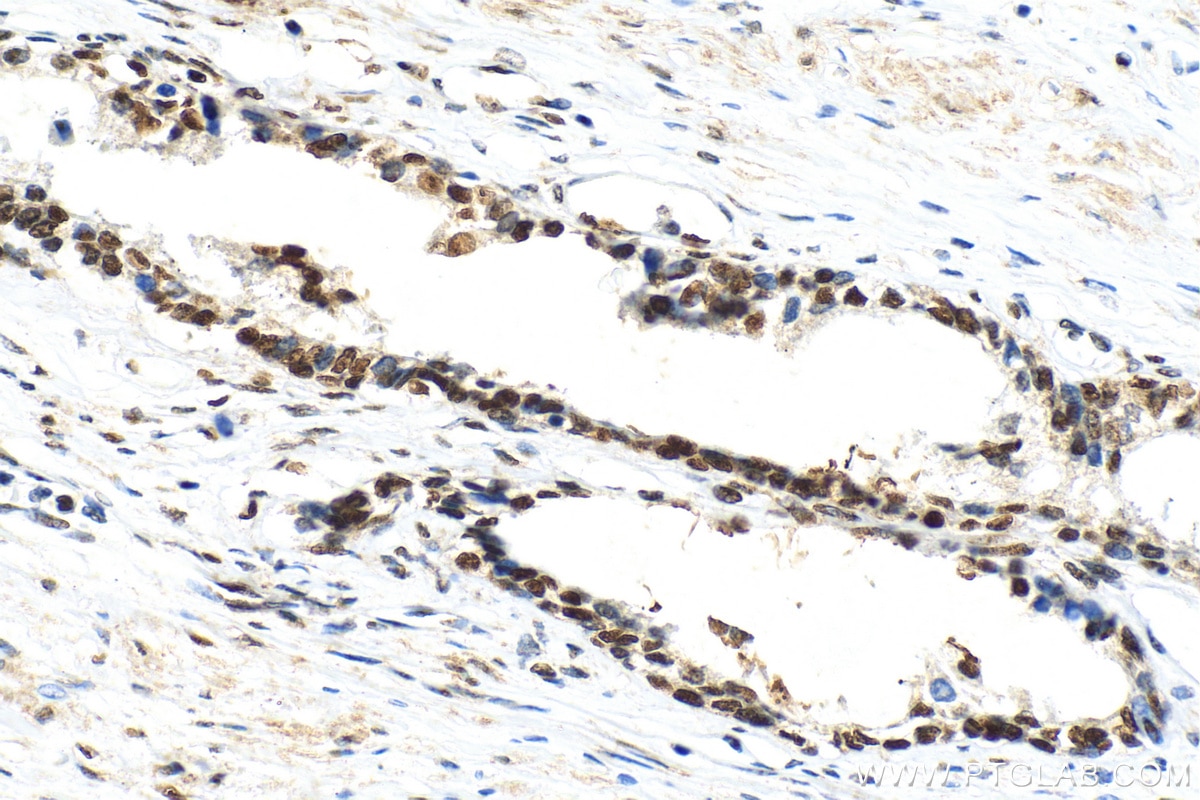 IHC staining of human prostate cancer using 82879-1-RR
