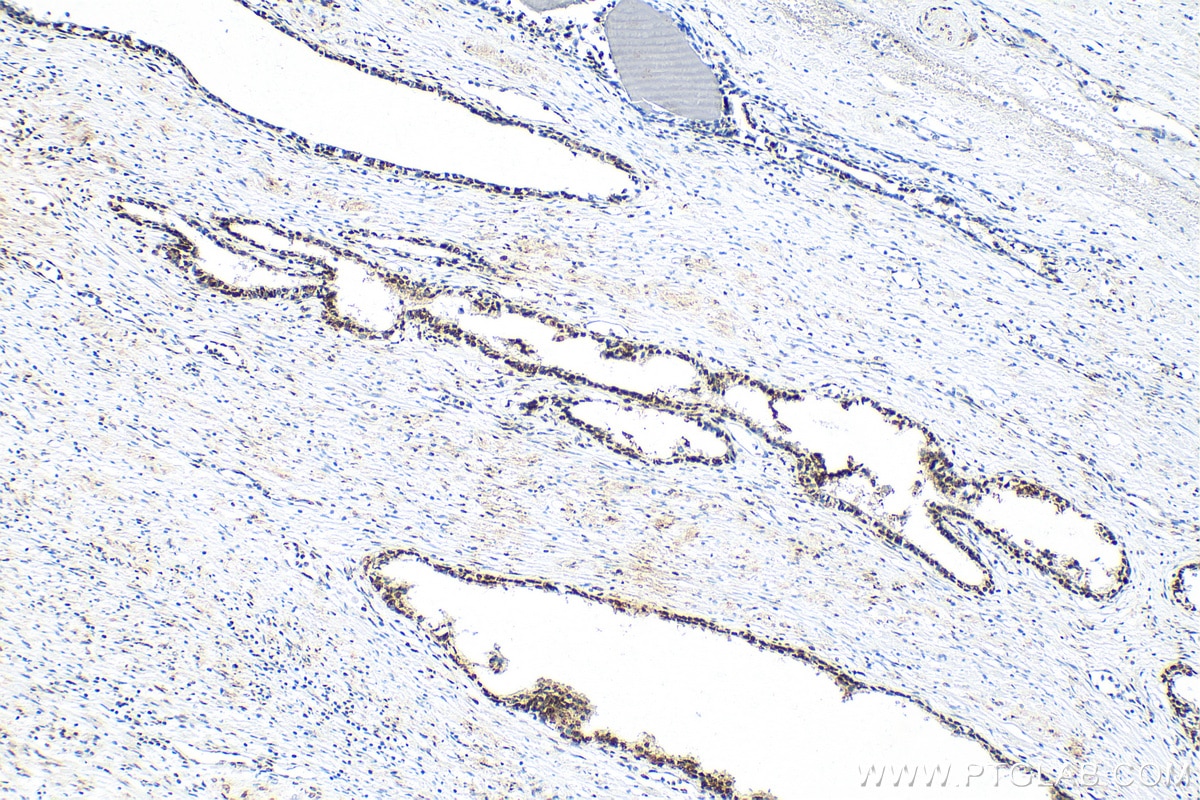 Immunohistochemistry (IHC) staining of human prostate cancer tissue using NOP58 Recombinant antibody (82879-1-RR)