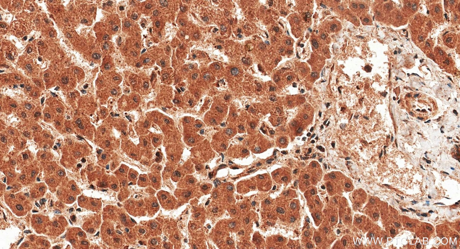 Immunohistochemistry (IHC) staining of human liver tissue using iNOS Polyclonal antibody (22226-1-AP)