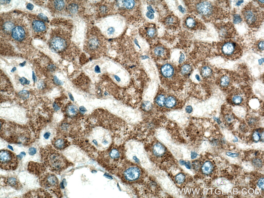 Immunohistochemistry (IHC) staining of human hepatocirrhosis tissue using NOSTRIN Polyclonal antibody (20116-1-AP)