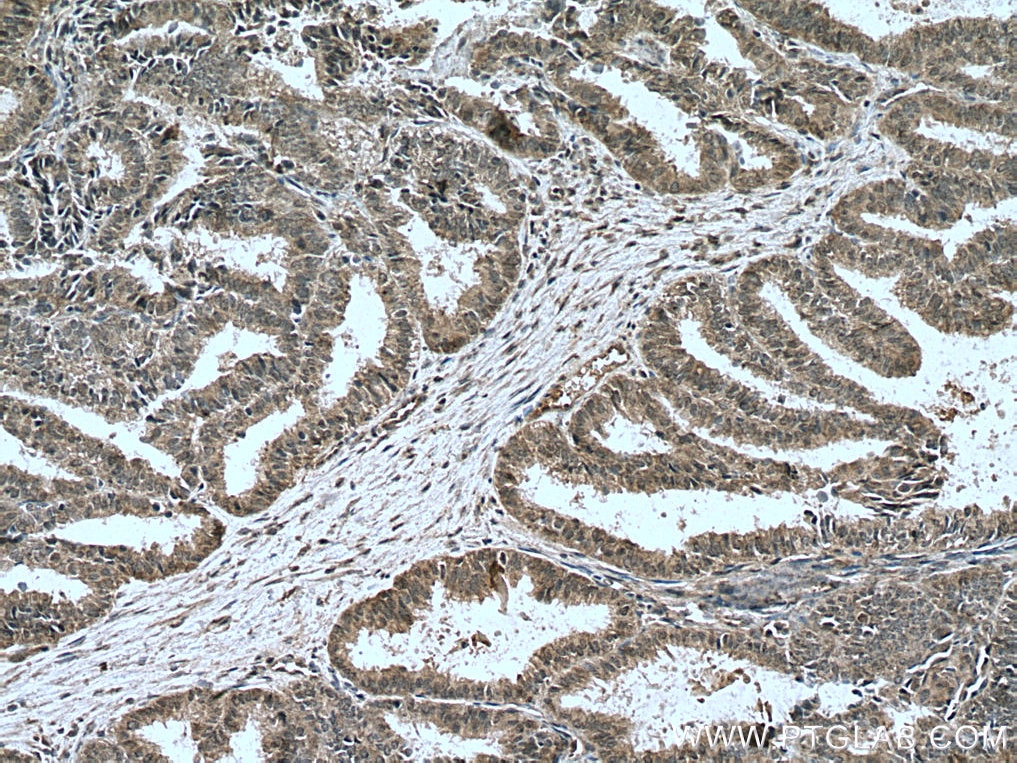 IHC staining of human ovary tumor using 20687-1-AP