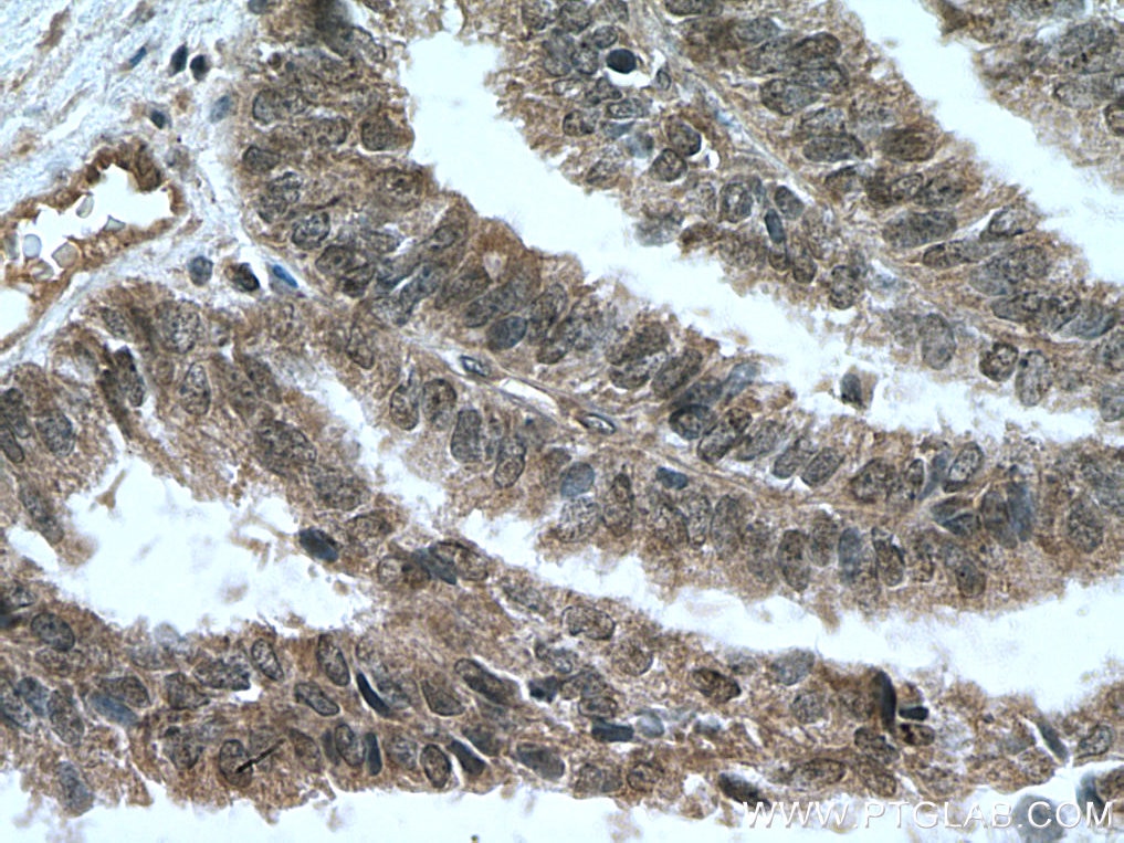 Immunohistochemistry (IHC) staining of human ovary tumor tissue using NOTCH1 Polyclonal antibody (20687-1-AP)