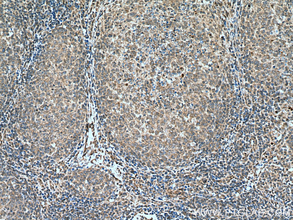 Immunohistochemistry (IHC) staining of human lymphoma tissue using NOTCH1 Polyclonal antibody (20687-1-AP)