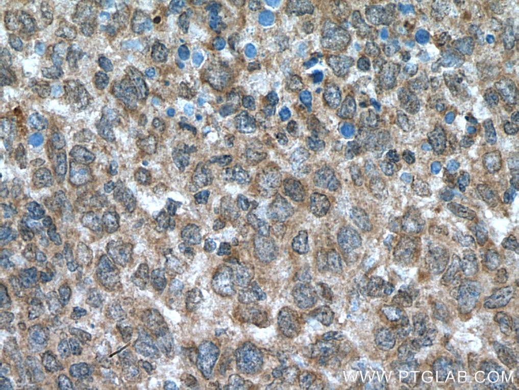 Immunohistochemistry (IHC) staining of human lymphoma tissue using NOTCH1 Polyclonal antibody (20687-1-AP)