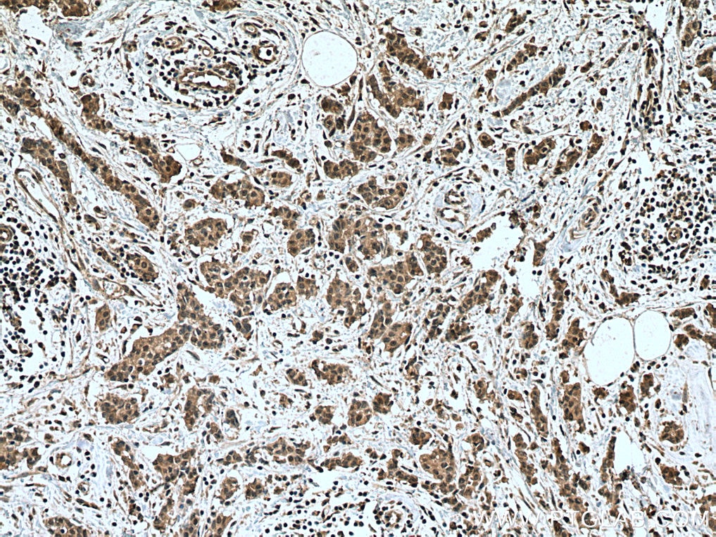 Immunohistochemistry (IHC) staining of human breast cancer tissue using NOTCH1 Polyclonal antibody (20687-1-AP)