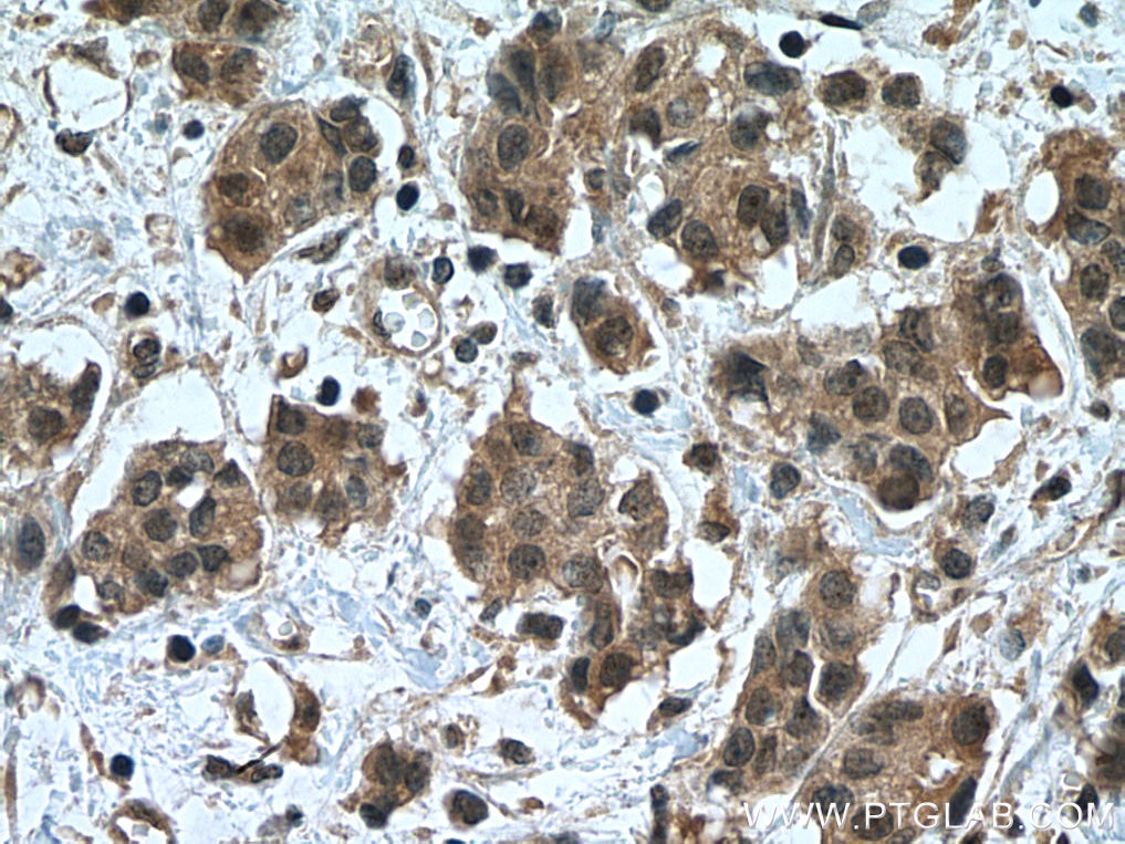 Immunohistochemistry (IHC) staining of human breast cancer tissue using NOTCH1 Polyclonal antibody (20687-1-AP)
