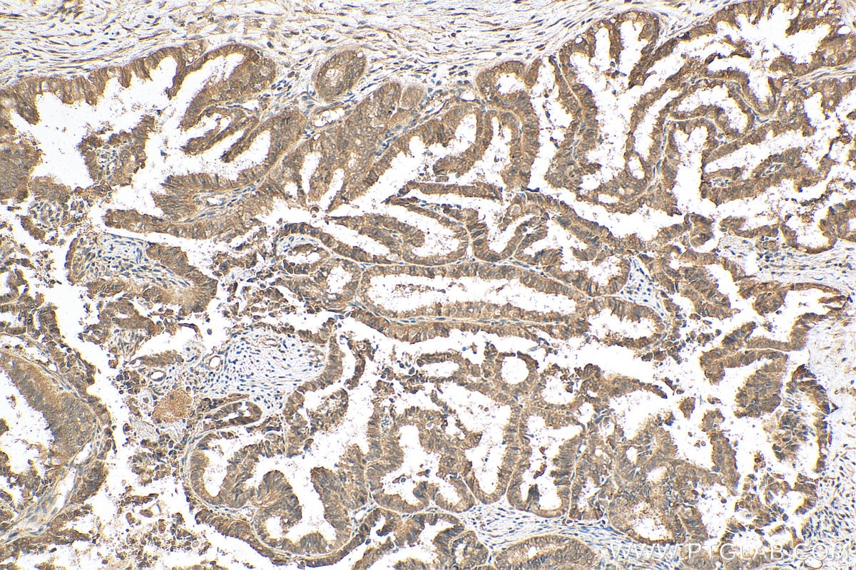 Immunohistochemistry (IHC) staining of human ovary tumor tissue using NOTCH1 Polyclonal antibody (20687-1-AP)