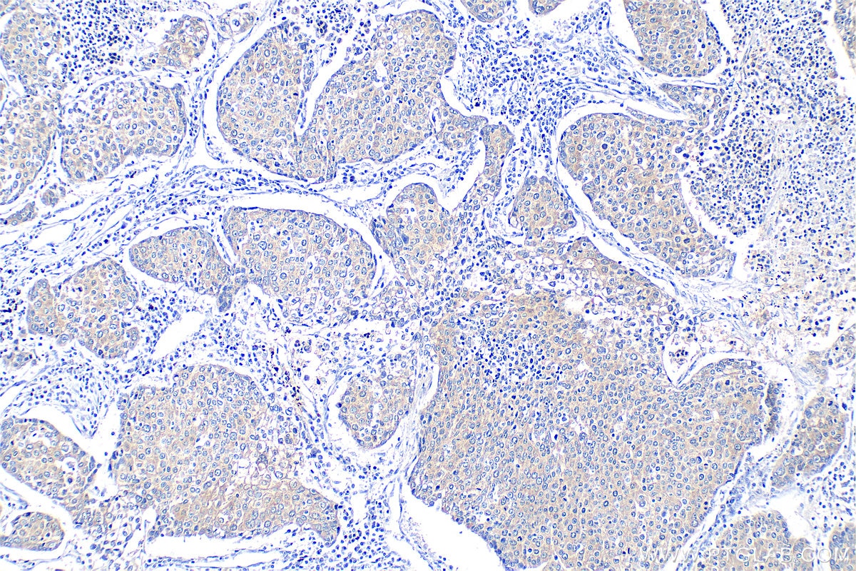 Immunohistochemistry (IHC) staining of human lung cancer tissue using NOTCH3 Polyclonal antibody (30540-1-AP)