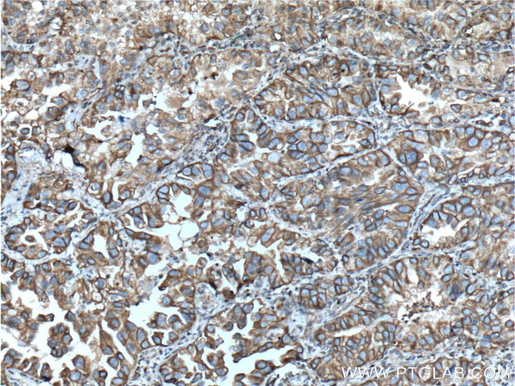 Immunohistochemistry (IHC) staining of human lung cancer tissue using NOTCH3 Polyclonal antibody (55114-1-AP)